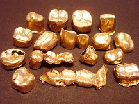 金歯