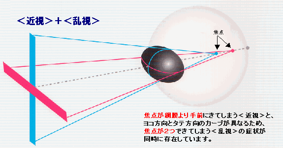 近視＋乱視